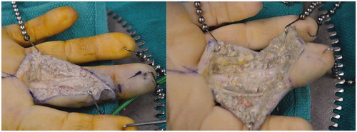 Figure 3. (left) Operative exploration with exposure of the neurovascular bundles and flexor sheath of the finger. The fresh white paint is clearly visible; (right) After extensive washout and initial debridement.