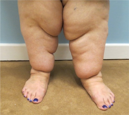 Figure 2 Characteristic “step-off” seen at the ankles in patients with lipedema.