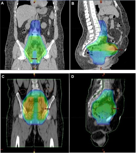 Figure 1 Initial-phase radiotherapy: (A,B) extended-field and (C,D) three-dimensional conformal radiation therapy (3D-CRT) plans showing 45 Gy to planning target volume (PTV)-1, in coronal (A,C) and sagittal views (B,D).