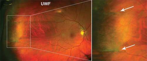 Figure 4. 66 year old Caucasian male meridional folds in the far temporal peripheral retina. White arrows highlight the folds within the magnified image. Abbreviations as in .Figure 2