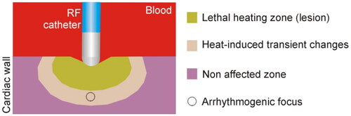 Figure 1. RF-induced lesion groups those cardiac cells that have been subjected to a lethal thermal dose which has resulted in irreversible changes in their electrical activity (e.g., irreversible loss of excitability and block). Around, other cells have been subjected to sublethal (moderate) heating, with the consequent transient electrical change (e.g., reversible loss of excitability and block) [Citation4,Citation5]. Further on are those cells that have been subjected to much milder heating and have also temporarily increased their rate of electrical conduction [Citation4] and finally cells that have not undergone temperature-induced changes since their temperature hardly changed during RFCA.