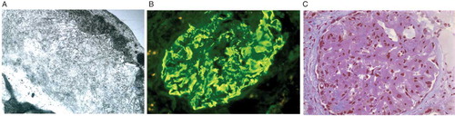 Figure 1. A. Histology showing diffuse glomerular infiltration by amorphous material (original 330 ×). B. Immunofluorescence showing amorphous deposits of IgG, C3, and C1q. C. Electron microscopy showing non-branching, randomly oriented fibrils in deposits (original 20,000 ×).