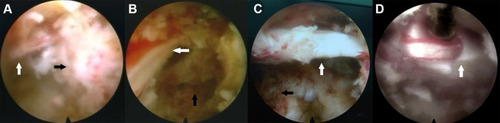 Figure 2 Intraoperative endoscopic views. (A and B) The superior endplate of the inferior vertebra (L5) was removed with an endoscopic bone knife. (C) Dorsal and ventral L5 nerve roots were fully decompressed. (D) The dura was torn with nucleus forceps. The white arrow represents the traversing nerve root (L5), and the black arrow represents the superior endplate of the inferior vertebra.