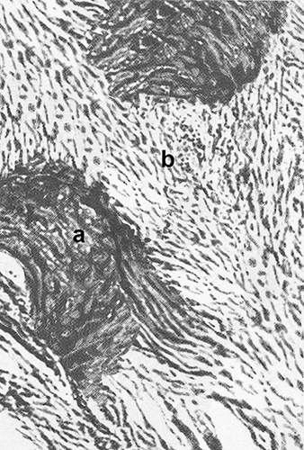 Figure 4 Microphotograph. Dissolution of bone beams of cancellous bone (a) bone-cartilaginous regenerate and its replacement by fibrous tissue (b). Haematoxylin and eosin staining. x130.