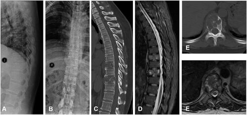 Figure 2 A 47-year-old female diagnosed with lung cancer treated with surgical decompression and pedicle stabilization combined with 125I brachytherapy seeds implantation. (A) Preoperative lateral X-ray showed T6 and T8 vertebral collapse. (B) Preoperative anteroposterior X-ray showed T6 and T8 vertebral collapse. (C) Preoperative lateral CT showed T6 and T8 bone destruction. (D) Preoperative lateral MRI showed T6 and T8 spine metastases. (E) Preoperative transverse CT showed bone destruction at T8. (F) Preoperative transverse MRI showed deformation of the dural sac due to metastatic tumor.