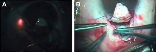Figure 4 Advancing microcatheter through SC (A) followed by Prolene suture placement (B).