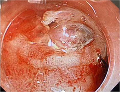 Figure 1 Picture of the duodenal bulb showing an ulcer with a central naked thrombus head and active bleeding on the surface.