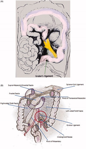 Figure 8. (A, B) The mesenteric-mesocolic ligament of Gruber is a peritoneal fold stretched from the root of the mesentery to the angle of insertion of the sigmoid mesocolon, the intersigmoid recess is a funnel-shaped area where the coalescence between the posterior aspect of the sigmoid mesentery and the peritoneum overlying the posterior abdomino-pelvic wall is missing.