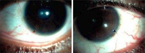 Figure 4 Eyes showing superficially embedded corneal foreign body.