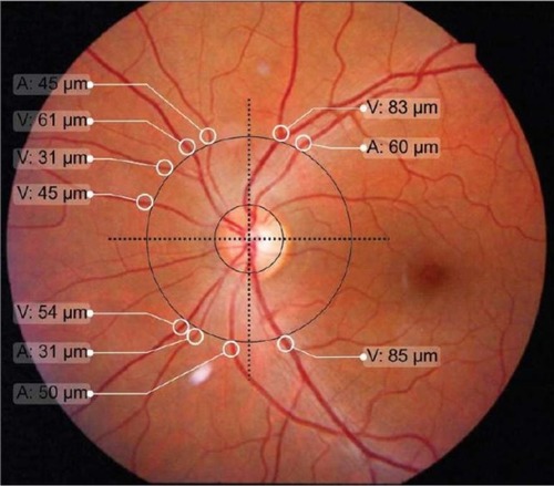 Figure 1 Definition of the optical disk, the greater circle and quadrants of the retina for quantification of the arteriole (A) and venule (V) microvasculature.