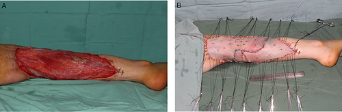 Figure 4 Skin grafting two weeks after debridement. (A) The necrotic tissue was completely removed, with a promising amount of fresh granulation tissue covering the wound before the skin graft operation. (B) The split-thickness skin graft was sutured to the wound.