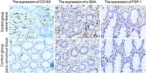 Figure 2 Representative immunohistochemical staining of CD163, α-SMA, and FSP-1 in control cancer tissues and paracancerous tissues (200x field). (a) CD163 expression in control CRC tissues (Arrows mark M2-type macrophages). (b) CD163 expression in control CRC paracancer tissues (Arrows mark M2-type macrophages). (c) Expression of α-SMA in control CRC tissues. (d) Expression of α-SMA in control CRC paracancer tissues. (e) Expression of FSP-1 in accurate control CRC tissues. (f) Expression of FSP-1 in control CRC paracancer tissues.