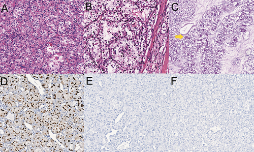 Figure 2 Histological findings and the results of special staining and immunostaining in case 3 are as follows: The tumor cells exhibit an organoid pattern (A) or a nest-like arrangement (B), with delicate fibrovascular septa separating them. PAS staining reveals the presence of purplish-red crystals in the cytoplasm (indicated by the yellow arrow) (C). Immunostaining shows diffuse positivity for TFE3 (D), while HMB-45 (E) and Melan-A (F) are negative. The original magnification for all images is 200×.