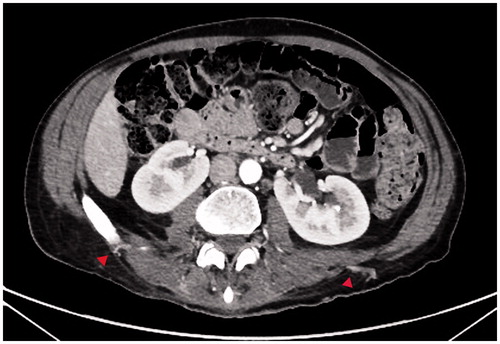 Figure 2. Pre operative angio-CT locating L4 lumbar perforators (red arrows).