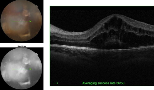 Figure 4. Uveitic macular edema in a child with JIA. The green line shows the section of the fundus that corresponds to the image in the right part of the figure. The image was taken using Topcon 3D-OCT 2000 FA plus ver.8.42.