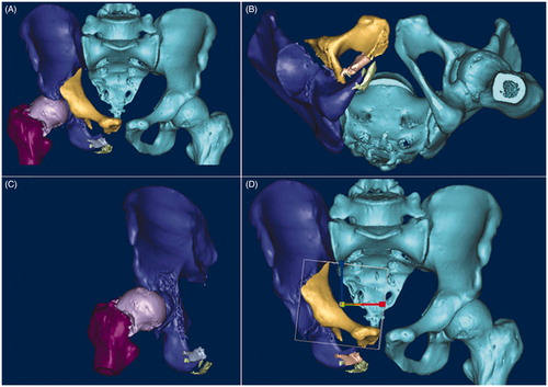 Figure 1. (A) Model of fractured pelvis prepared for virtual surgery; (B) The pelvis could be rotated; (C) Every fragment could be subtracted. It could give the surgeon insight into their spatial relation and help to choose the operative approach; (D) Every fragment could be moved.