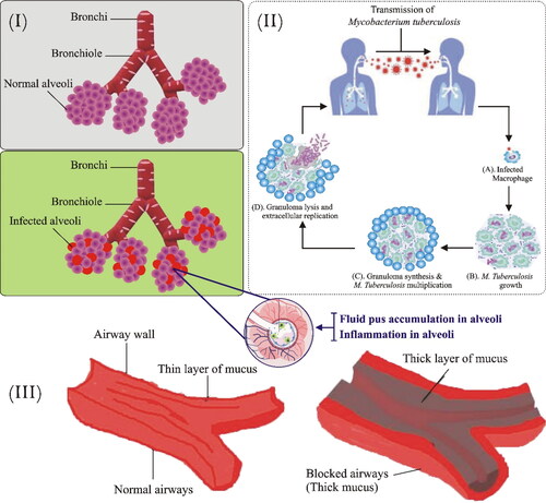 Figure 2. Bacterial respiratory infectious diseases. i. Pathophysiology of pneumonia: Pathogens enter via inhalation and reach lower airways. Alveoli releases cytokines and inflammatory mediators which lead to alveolar fluid accumulation. ii. Pathogenesis of TB: M. tuberculosis enters the respiratory tract through inhalation and infects alveoli. In the first step, alveolar macrophages recognize, engulf, and try to destroy bacilli. In the second step, bacilli start to grow within the infected alveolar macrophages which ultimately transform into granuloma. Most human with infected TB don’t exhibit a progression of the disease and remains in a latent state. However, some infected persons progress to the final stage where cavities are filled with free-floating bacteria and spread in the lungs causing pulmonary TB. iii. Comparison of normal and Cystic fibrosis patient airways- Illustration showing normal and highly viscous mucus airways in lungs and respiratory tubes.