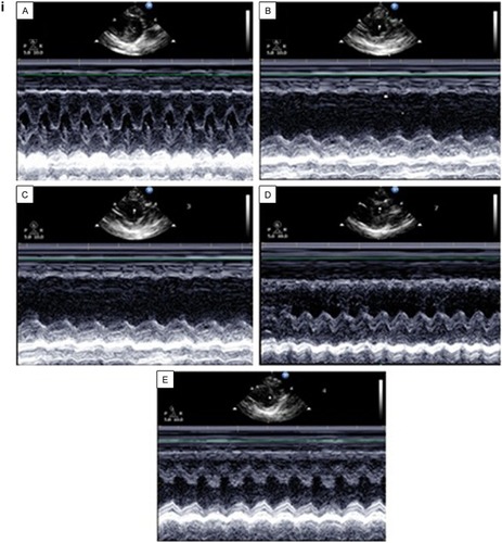 Figure 1 (i and ii) Echocardiography after 4 weeks of AMI.