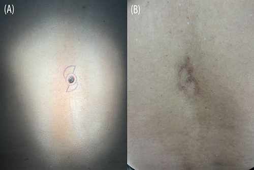 Figure 4 A 63-year-old man had basal cell carcinoma on the midline of the lower back with a 10-year history. A biopsy was obtained from the skin lesion and confirmed the diagnosis. (A) Preoperative view of the patient. (B) Postoperative view 3 months after surgery.