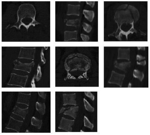 Figure 5. Extended DCGAN generated different spine fracture type images.