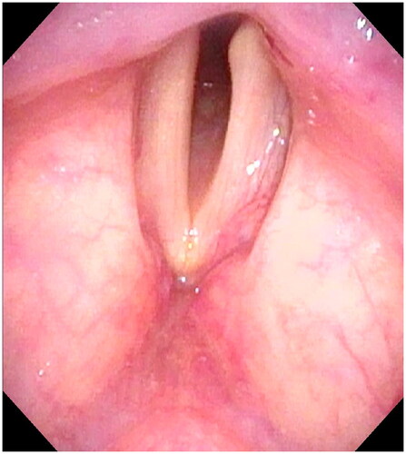Figure 4. Endoscopic imaging findings 7 weeks after the initial visit. Bilateral vocal cords are completely fixed and the glottic space is present. No necrotic tissue is visible.