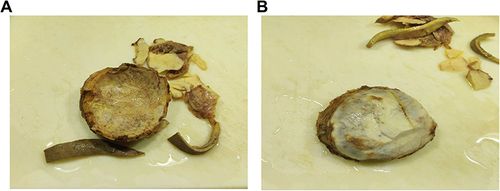 Figure 6 (A and B) Gross pictures showing, a 13 x 12cm slightly irregular Bifrontal calvarial bone with 1.5–3 cm thickness and two separate irregular skin tissues larger measuring 13 x 8cm, smaller measuring 10×2 cm.