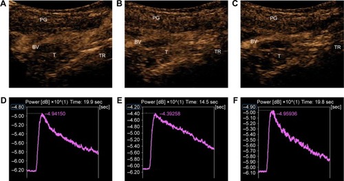 Figure 2 DCE-US imaging and TIC of NPC in a 60-year-old female of the ES group at different time points after administration of RHES.