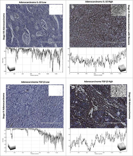 Figure 2. IL-10 and TGF-β staining of colon adenocarcinoma tissue. Each tissue is displayed with the gray scale image, with an applied threshold, in the top right corner of the image. Below each image is the intensity map of the tissue with the gray values on the Y-axis. Within each of the intensity maps is a graphical representation of the level of gray staining. The scale bar indicates a magnification of 200. (A) Tissue from a 66-year-old female with Stage IIB colon adenocarcinoma who showed minimal levels of IL-10 expression characteristic of approximately 80% of patients. (B) Tissue from a 78-year-old female with stage III adenocarcinoma who experienced a significant upregulation of IL-10 within her tumor, which was characteristic of approximately 20% of the patients. (C) Tissue from a 64-year old male with stage III adenocarcinoma. This individual was rare among the samples analyzed as he had no visible staining of TGF-β. (D) Tissue from a 71-year old male with stage IIB adenocarcinoma, who had significant levels of TGF-β characteristic of only 13% of the tissues.