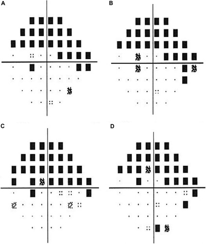 Figure 4 Humphrey visual fields show stable left visual fields following gold shunt surgery with MD of −11.84 dB at 1.5 years later (A), −12.21 dB at 2.5 years later (B), −14.20 dB at 3.5 years later (C), and −13.11 dB at 4.5 years later (D).