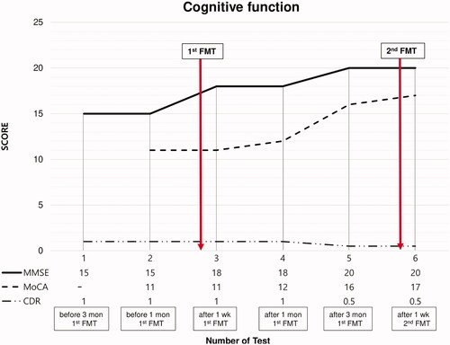 Figure 1. Timeline of the fecal microbiota transplantation and cognitive function tests. The cognitive function test scores improved after fecal microbiota transplantation (Mini-Mental State Examination [MMSE], red line; Montreal Cognitive Assessment [MoCA], green line; Clinical Dementia Rating [CDR], blue line).