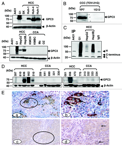 Figure 3. GPC3 protein expression in liver cancer. (A) GPC3 expression in liver cancer cell lines detected in western blotting. HCC: hepatocellular carcinoma; CCA: cholangiocarcinoma. 1G12: a commercial GPC3 mAb. Mz: Mz-ChA-1; SK: SK-Hep-1. (B) western blots of ovarian clear cell carcinoma (CCC). TOV-21G: ovarian CCC. (C) Soluble GPC3 protein immunoprecipitated from culture supernatant and analyzed by western blotting. YP7 was used to pull down soluble GPC3 protein in culture supernatant. H: mouse IgG heavy chain; L: mouse IgG light chain. C-terminus: C-terminal subunit (~30 kDa). IP: immunoprecipitation. (D) GPC3 expression analyzed by western blotting in nine HCC and nine CCA primary liver tumor tissues. (E) Immunohistochemistry of GPC3 in HCC tissues. Circles identify tumor nests (a, c) with or without distinct GPC3 positivity at a low magnification. Arrows identify tumor (b, d) with or without GPC3 positivity at a higher magnification. a, c: 100X. b and d: a higher magnification (400X) of a and c, respectively.