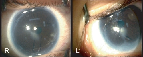 Figure 1 Operating room photographs of right eye (R) and left eye (L) showing paracentral corneal opacities with peripheral anterior synechiae and adhesions between the iris and the cornea.