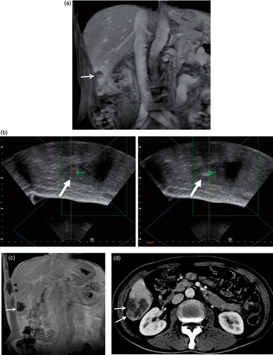 Figure 3. A 63-year-old man with multiple hepatic metastasis from colon carcinoma. Initial contrast enhanced coronal T1-weighted MR image shows one (arrow) of three metastatic nodules to the right lobe of liver (a). Ultrasonographic images showing the target before (b, left image) and after HIFU ablation (b, right image) demonstrate the hyperechoic changes representing optimal ablation. Follow-up contrast-enhanced coronal T1-weighted image two weeks after HIFU shows complete coagulative necrosis of the lesion (arrow). Pericostal ablation is noted in the sonification port (arrowheads) (c). Further follow-up contrast-enhanced CT 114 days after HIFU shows interval increase of the tumor size (arrows), indicating recurrence (d).