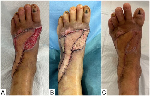 Figure 9. Clinical course after flap transfer. (A) The flap survived without necrosis. (B) A full thickness skin graft was performed. (C) The soft tissue healed completely 2 months after the injury.