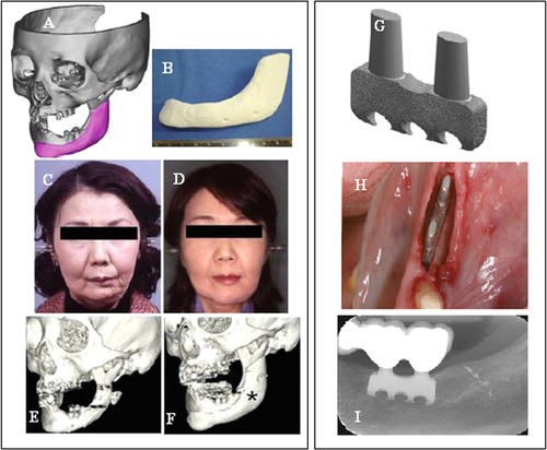 Figure 5. Clinical application of custom-made artificial bone from α-TCP using inkjet 3D printing (left) (reproduced from H Saijo et al 2009 J. Artif. Organs 12 200–5, with kind permission from Springer Science and Business Media) and custom-made SLS titanium blade implants (right) (reproduced from F Mangano et al C 2013 Lasers Med. Sci. 28 1241–7, with kind permission from Springer Science and Business Media). Left: (A) Extraction of the CAD data of the created artificial bone (red) based on a CT image. (B) Macroscopic image of the inkjet-printed custom-made artificial bone (IPCAB). (C) Facial appearance 1 year after surgery. (D) 3D CT image of the left lower jaw before surgery. (E) 3D CT image of the left lower jaw 12 months after surgery. Right: (G) CAD file of the custom-made SLS titanium blade implant. (H) The custom-made SLS blade implant placed in position. (I) The radiographic control two years after implant placement.