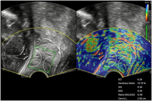 Figure 1. Cervical elastography image of women with a short cervix at 24 weeks of gestation. A 2-dimensional grayscale image (left) and an elasticity image (right) are simultaneously displayed on the screen. Elastographic parameters and cervical length are shown in the bottom right corner of the screen.