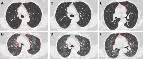 Figure 1 Application of the proposed algorithms on the CT scans of a COPD patient.