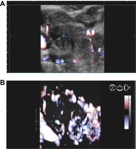 Figure 1 (A) Low intra- and peri-nodular vascularisation pattern observed on 2D examination. (B) Low intra- and peri-nodular vascularisation observed on 3D examination (same thyroid nodule).