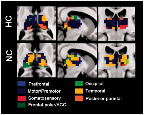 Figure 4. “Winner take all” displays the altered spatial extent functional thalamic ROIs between both thermal conditions. In HC group, sensorimotor-thalamic connectivities encompass a greater portion of the thalamus, whereas prefrontal and temporal areas encompass much less of the portions of the thalamus.