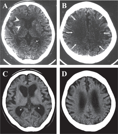 Figure 1 Computed tomography (CT) images in December 2000 showed decreased density at the right caudate head (A, arrowheads) and in the bilateral cerebral white matter (B, arrows). Those in November 2007 (C, D) showed marked cortical atrophy and dilatation of ventricles.