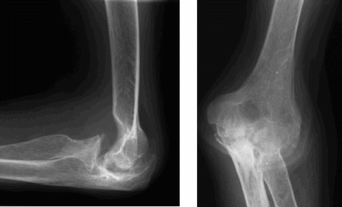 Figure 1 a. Preoperative lateral view. b. Preoperative anteroposterior view. Pre- and postoperative radiographs of the GSB III elbow arthroplasty in a 58-year-old woman with severe rheumatoid destruction of the elbow joint.