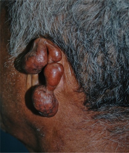 Figure 3 Local destruction of the left auricle, presenting exophytic erythematous-brownish lesion, with a pedunculated aspect and telangiectasias.