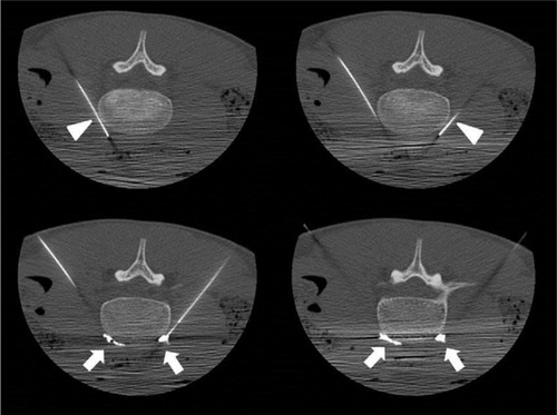 Figure 4 Axial CT fluoroscopy images patient 2