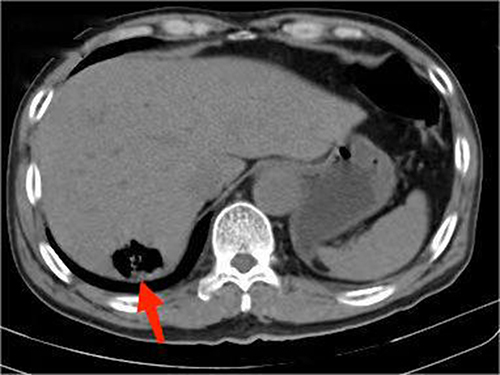 Figure 5 Computer tomography of the abdomen. The right lobe of the liver shows an inflated area (marked by a red arrow) and is accompanied by perihepatic fluid exudate.
