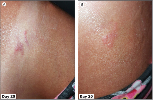 Figure 3 Typical serpiginous tracts with erythematous rash at Day 20 in a woman after a tourist trip to Thailand (A and B).
