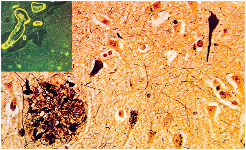 Figure 3. Histological lesions in Alzheimer’s disease. Neurofibrillary tangles, neuropil threads, neuritic plaques (lower left) and amyloid angiopathy (upper left insert).