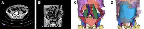 Figure 1 CT examination and three-dimensional reconstruction of incisional hernia. (A) Transverse section examination of CT. (B) Coronal section examination of CT. (C) Abdominal wall defect. (D) Three-dimensional reconstruction of incisional hernia with mesh.