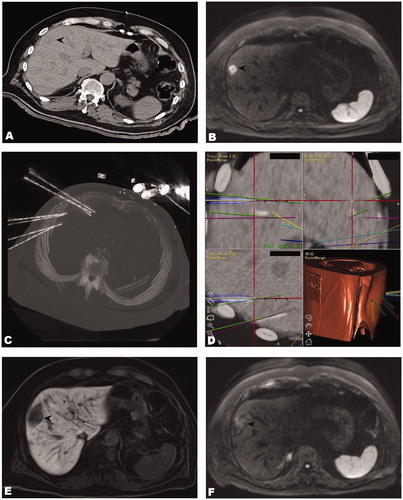 Figure 3. Case of a 71-year old male with two max. 2.4 cm large colorectal cancer liver metastases. (A) Unenhanced CT-image of an ‘invisible’ colorectal liver metastasis (black arrowhead). (B) Corresponding MR image (diffusion weighted sequence). (C) Maximum intensity projection (MIP) of the control CT with 7 coaxial needles in position. (D) Fused images of the control and planning CTs showing inserted coaxial needles and superposition of planned paths. (E, F) The black arrowheads illustrate the ablation zones on MR images at 3 months after SRFA without evidence of local recurrence.