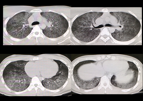 Figure 2. Postmortem pulmonary thoracic CT findings. CT reveals diffuse lung edema.