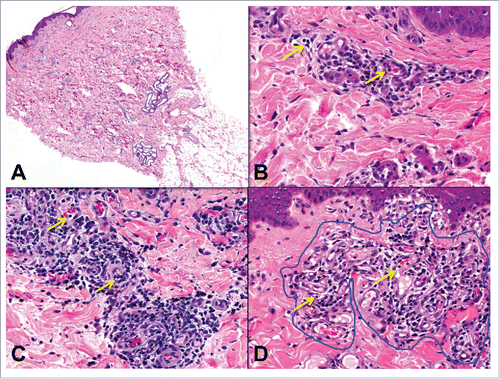 Figure 4. Histologic features of porcine skin and skin-containing VCA and pathologic component scores. A) Normal pig skin, punch biopsy. B) Minimal perivascular infiltrate (pc0) with capillaritis (c1) (arrows) in the superficial dermis. C) Moderately dense perivascular inflammation (pc2) with more evident capillaritis (c2) (arrows) at 40x magnification. D) The perivascular infiltrate surrounds dilated superficial dermal capillaries (pc1) occupying more than half of the field at 40x magnification (pa2) (outlined in blue). Dilated capillaries show occasional intraluminal mononuclear cells (c1) (arrows).